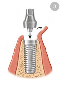 dental implants