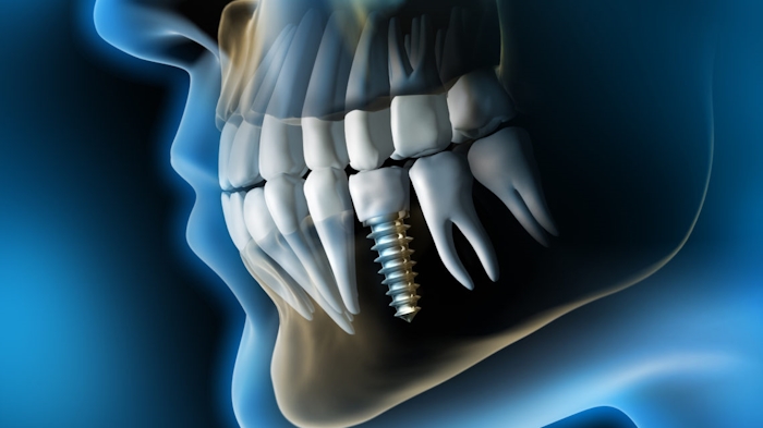 dental implants thessaloniki
