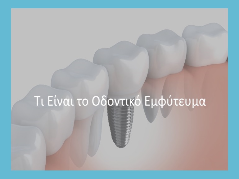 οδοντιατρικα εμφυτευματα